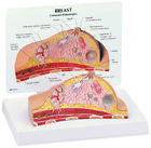 3450 Gpi New Anatomical Breast Cancer Cross Section Model 700358304934